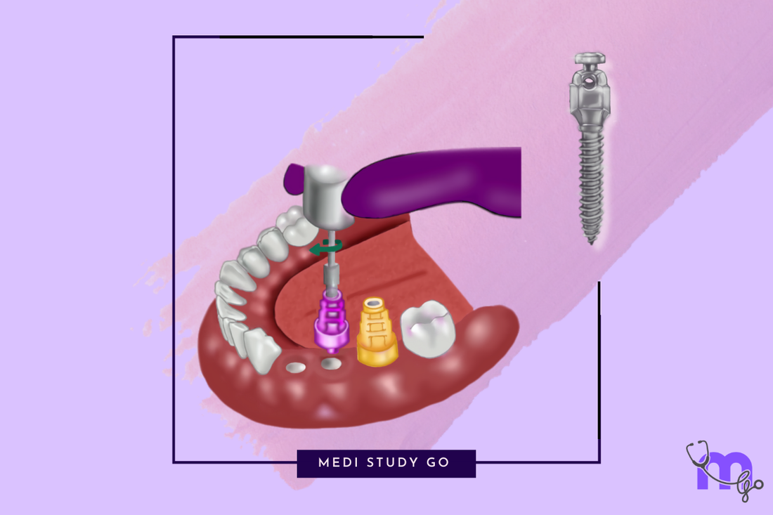 Impression technique