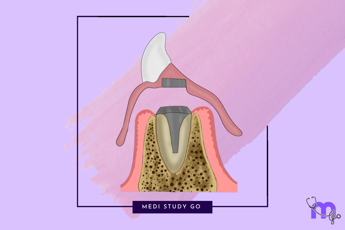 Magnetic attachment - Keeper element - detachable, attached to teeth.The denture retention element has paired, cylindrical, cobalt-samarium magnets