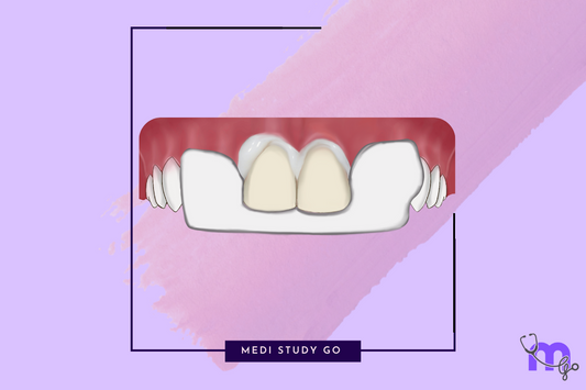 Cementation of crowns and bridges