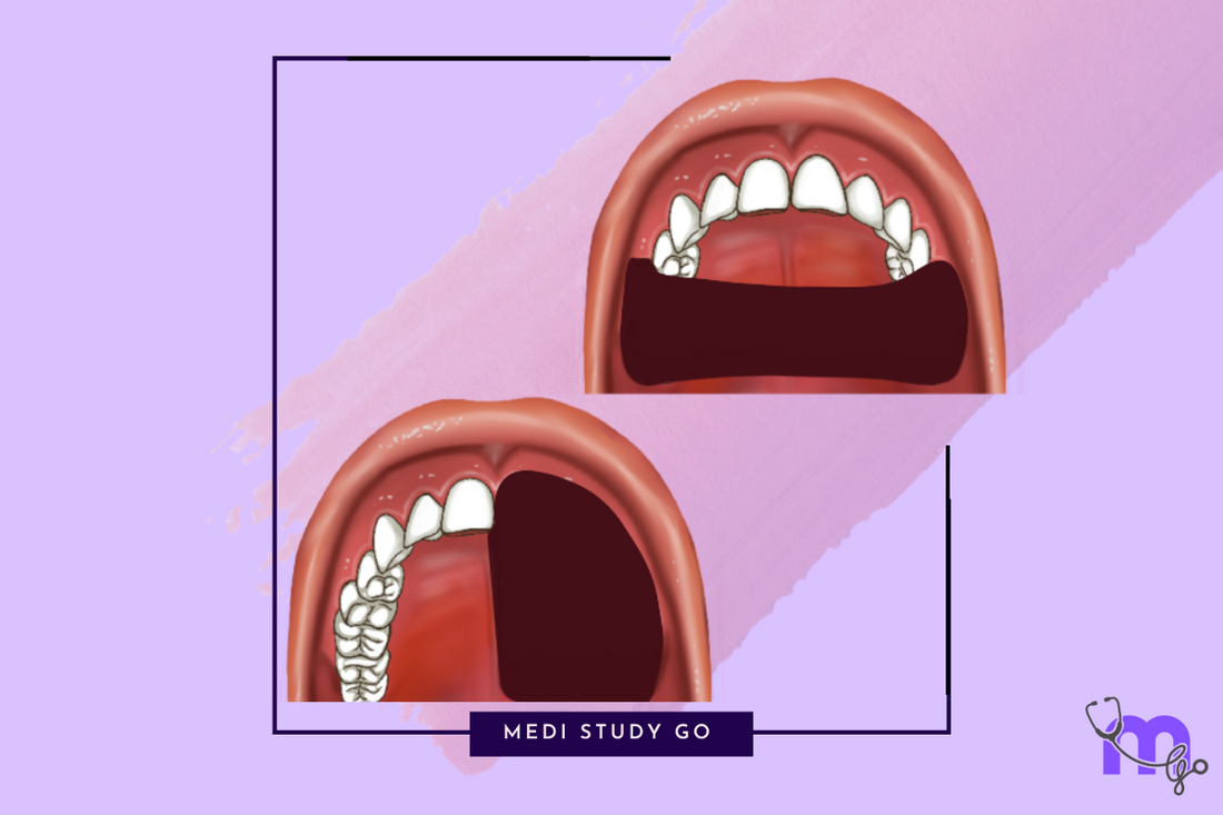 Aramany’s Classification