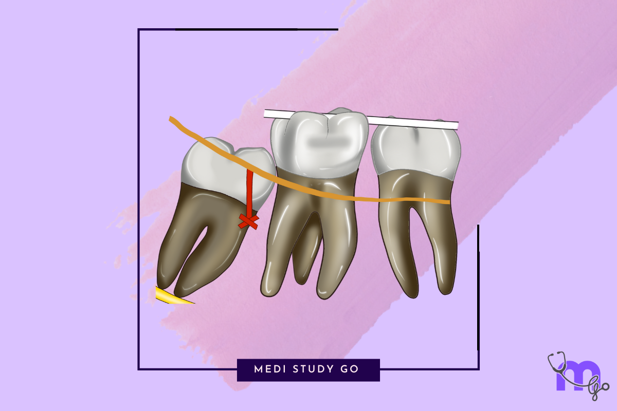 Classification of Dental Impactions: A Detailed Guide for Dental Stude ...