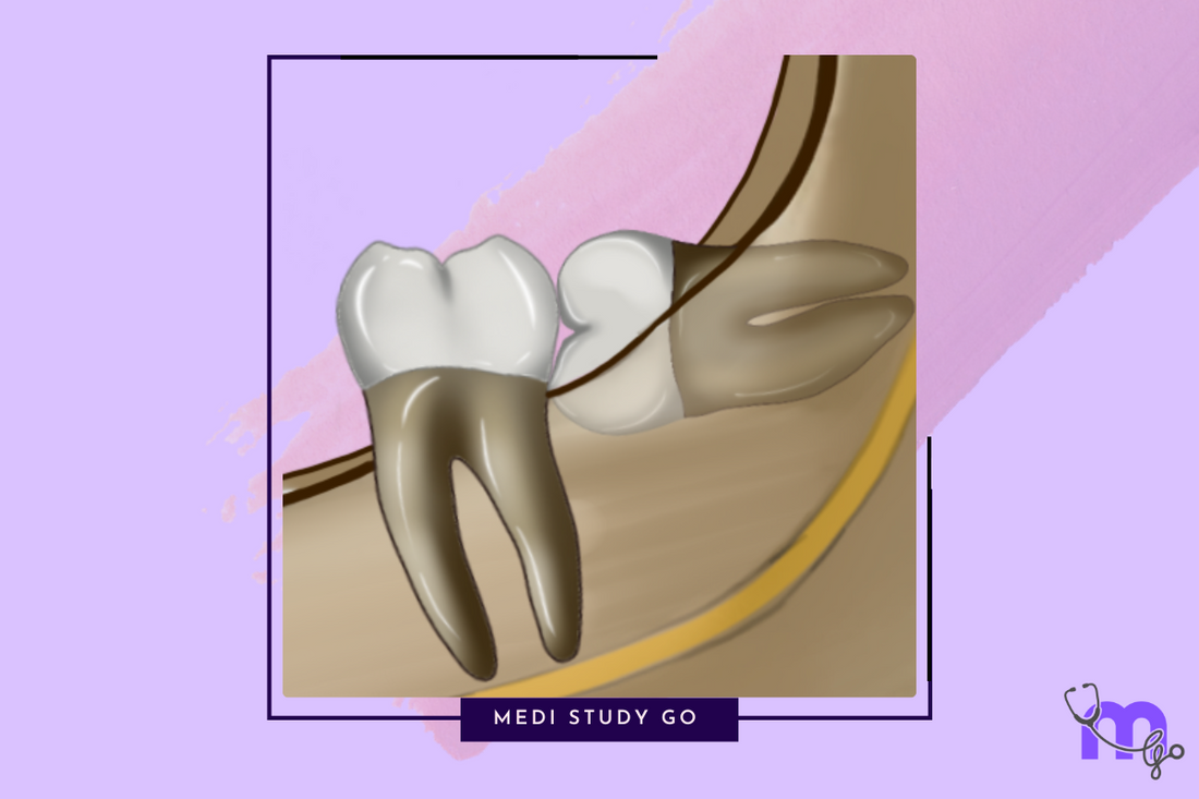 Impaction