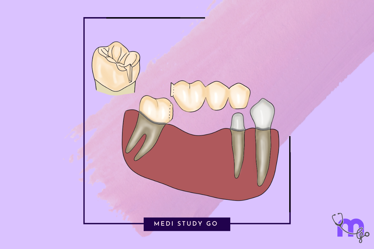 Dental Pontic Types