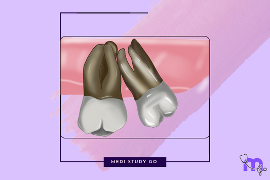 Impaction