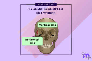 Zygomatic Complex Fractures: Diagnosis and Surgical Approaches – Medi ...