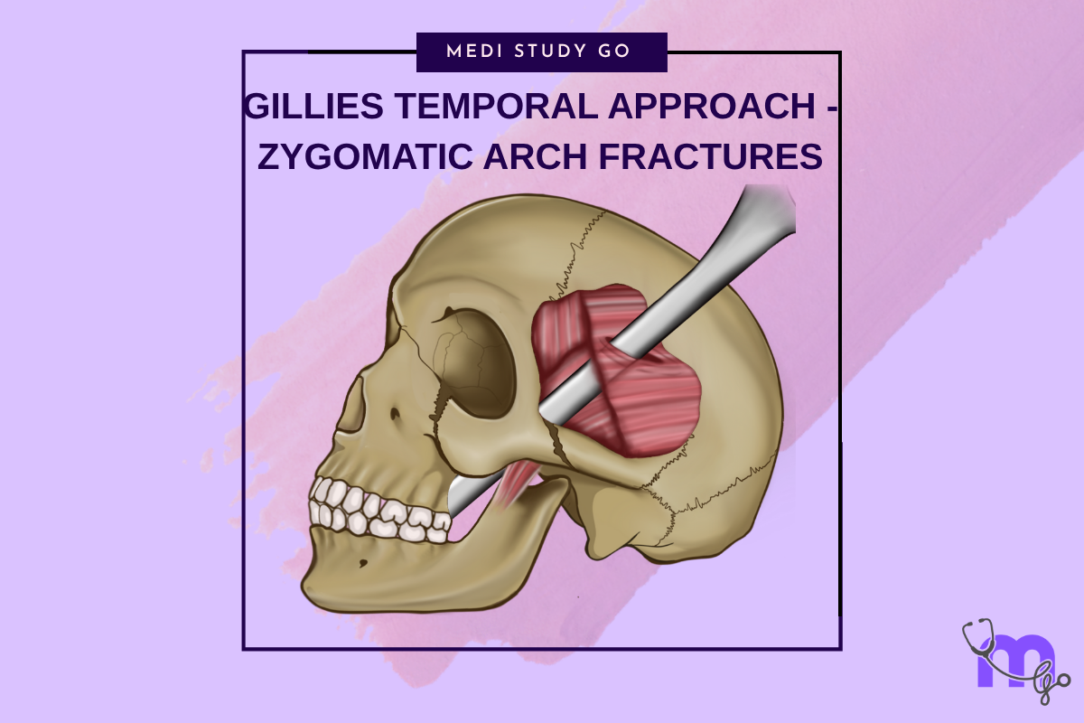 Gillies Rake Gillies Temporal Approach in Zygomatic Arch Fractures – Medi Study Go