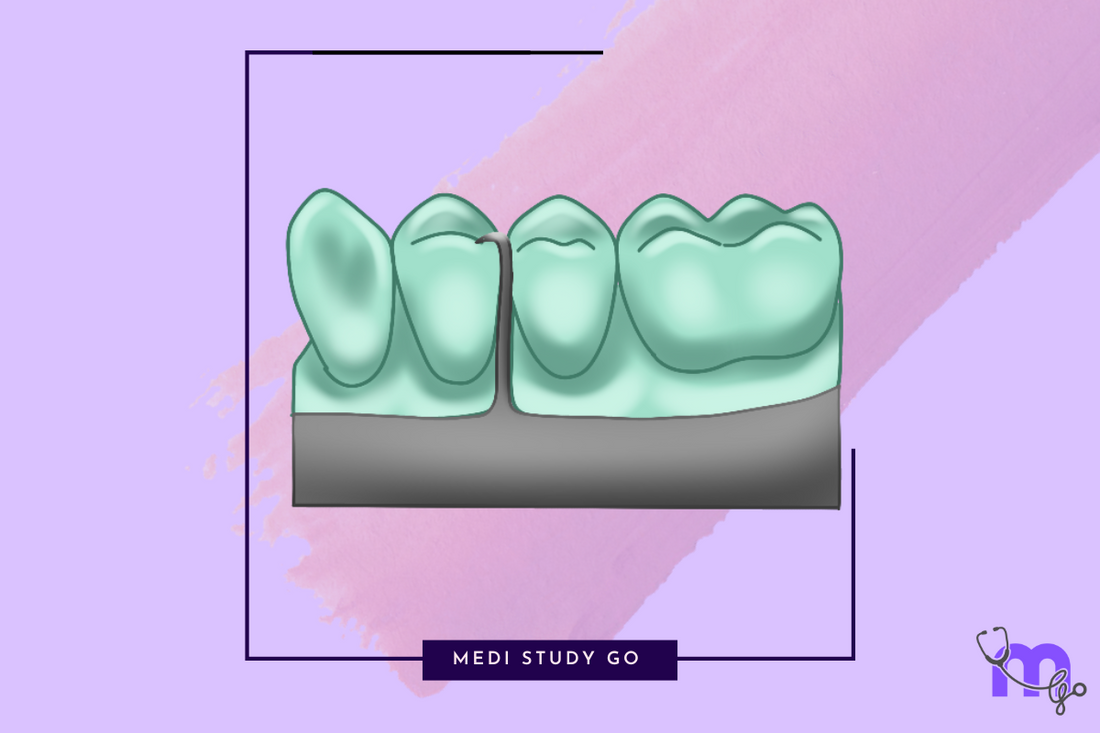 Rest and Rest Seats in RPD: Clinical Applications – Medi Study Go