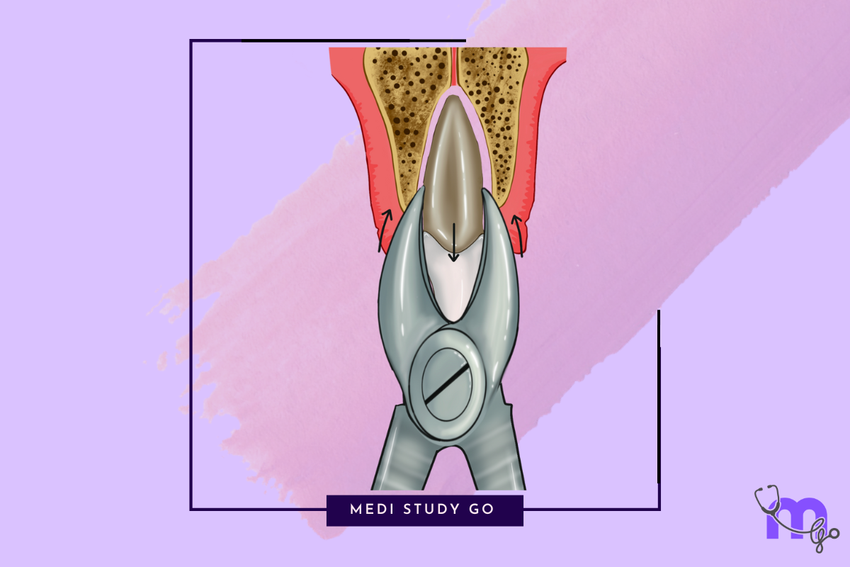 Surgical Extraction Procedures: A Comprehensive Guide – Medi Study Go