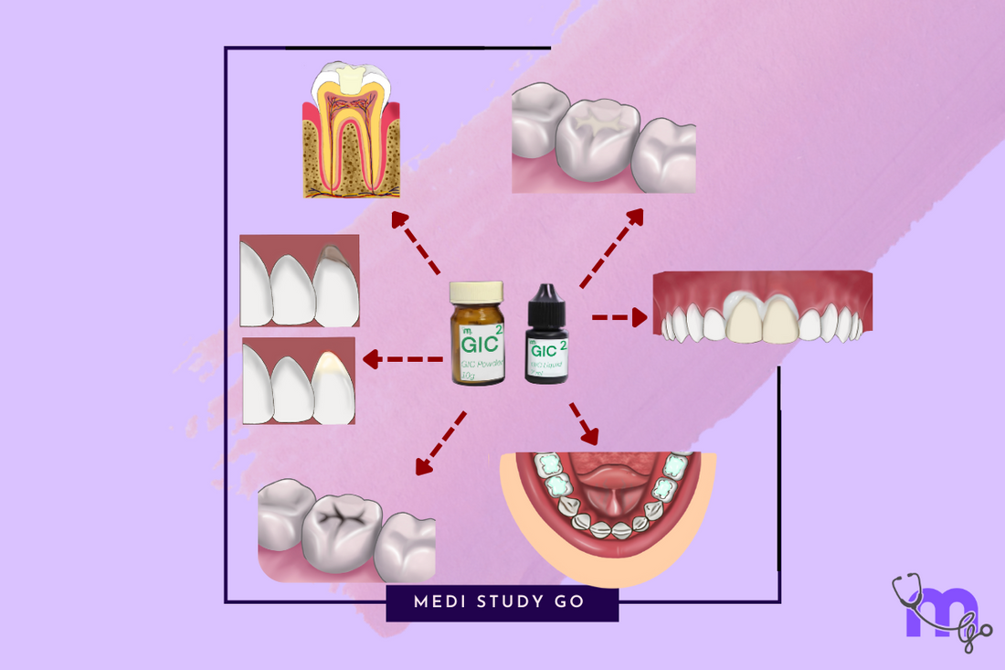 Glass Ionomer Cements (GICs)